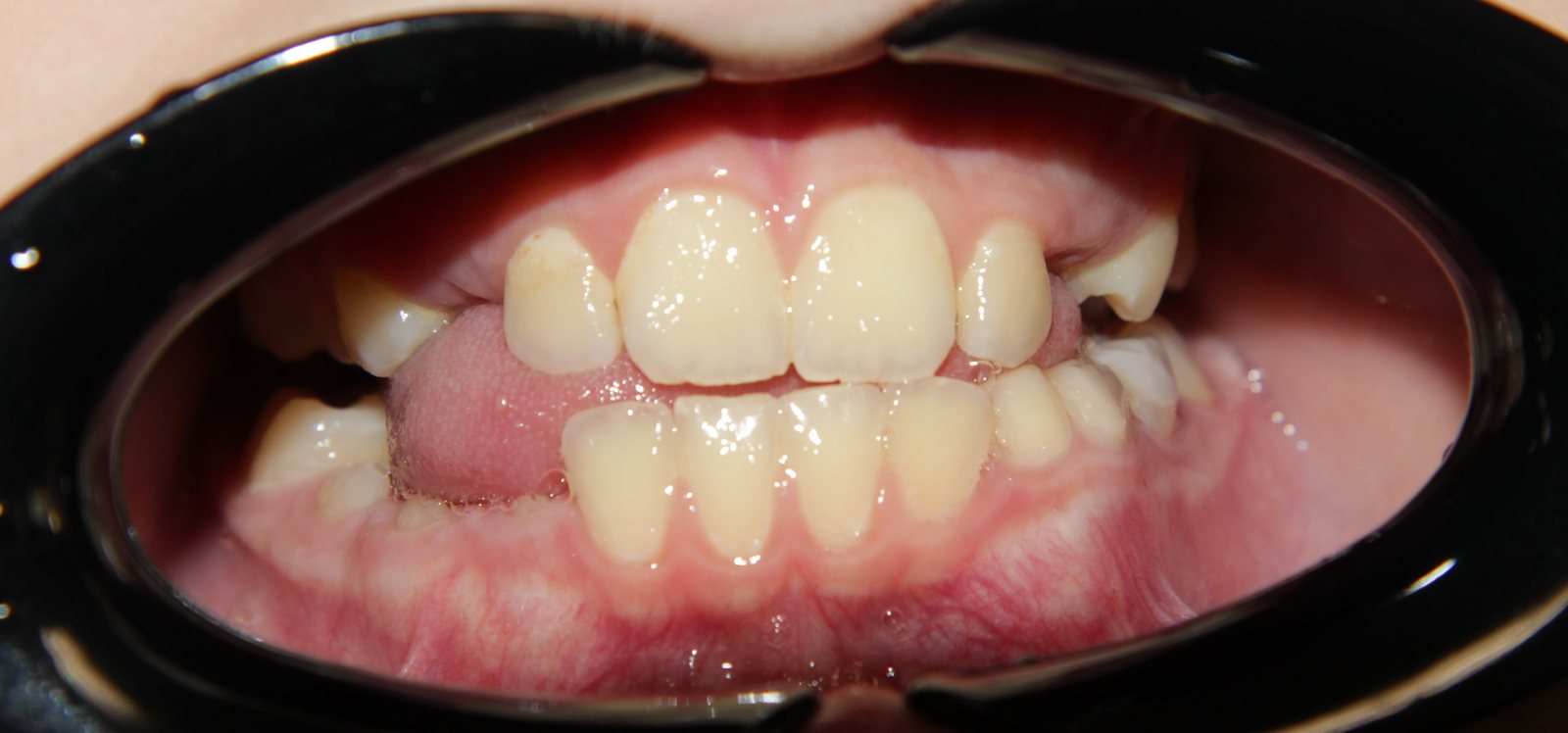 Зубы до установки аппарата, вид спереди