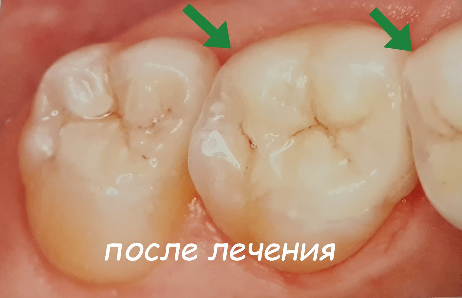 Тот же зуб после лечения