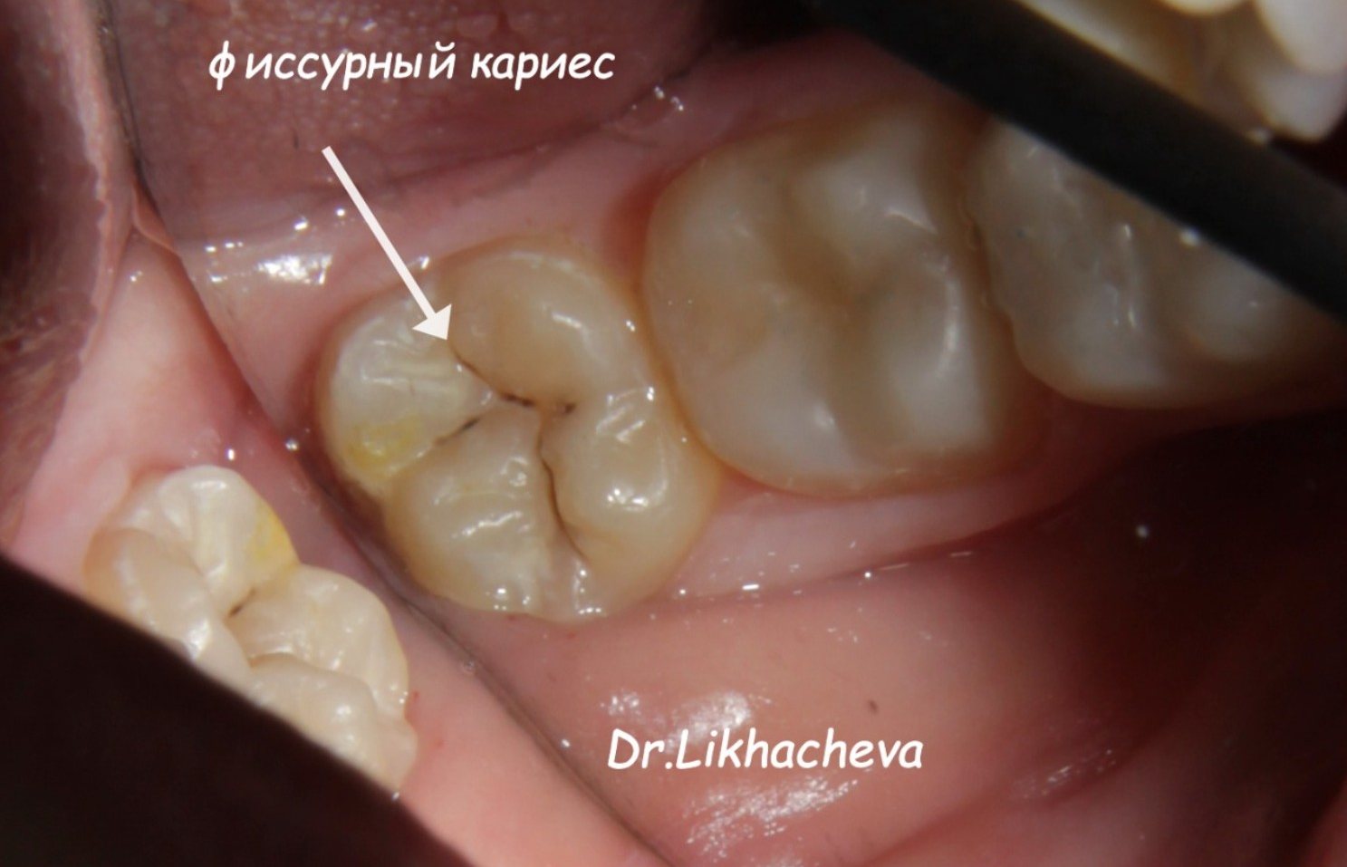 Фиссурный кариес на жевательном зубе, стрелкой отмечено место