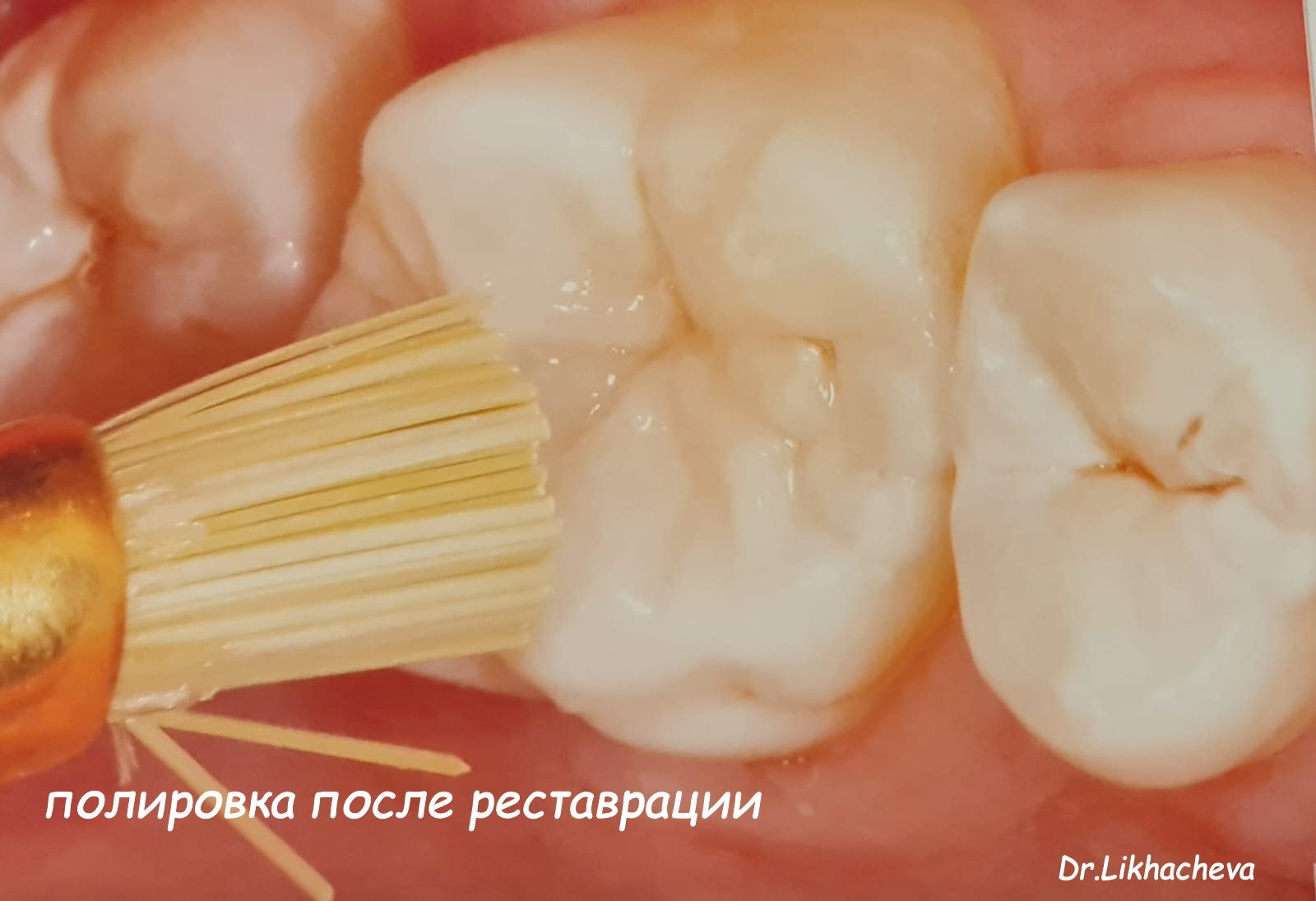 Полировка зуба после реставрации